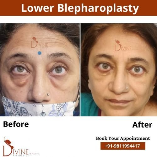 Lower-Blepharoplasty.png-nggid0290-ngg0dyn-500x500x100-00f0w010c010r110f110r010t010