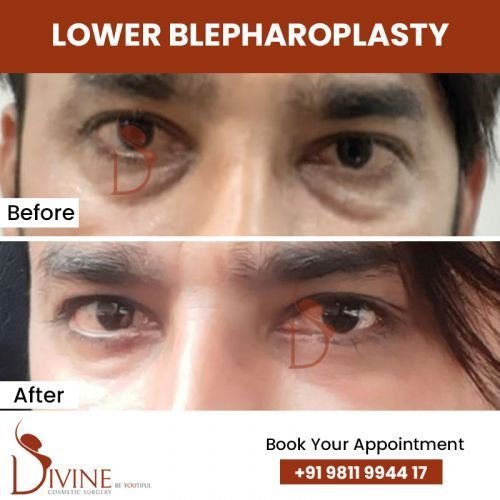 Lower-blepharoplasty.jpg-nggid0284-ngg0dyn-500x500x100-00f0w010c010r110f110r010t010