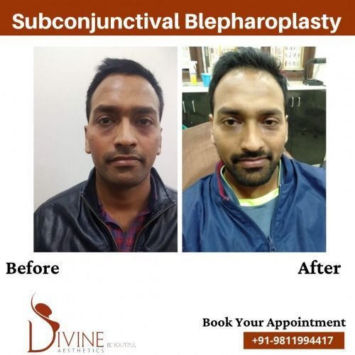 Subconjuctival-Blepharoplasty-Before-After-1-Feb-22.jpeg-nggid03485-ngg0dyn-500x500x100-00f0w010c010r110f110r010t010
