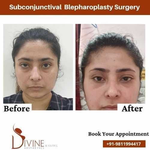 Subconjunctival-Blepharoplasty-Surgery.jpeg-nggid0293-ngg0dyn-500x500x100-00f0w010c010r110f110r010t010