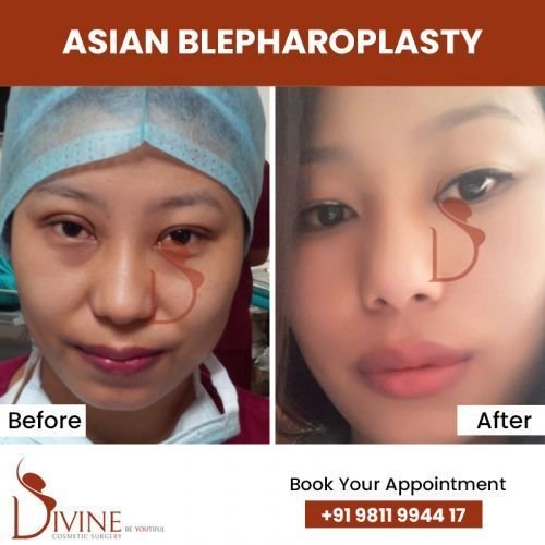 asian-blepharoplasty.jpg-nggid0287-ngg0dyn-500x500x100-00f0w010c010r110f110r010t010