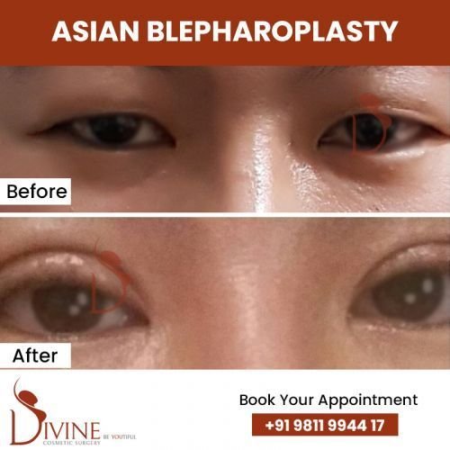 asian-blepharoplasty1.jpg-nggid0288-ngg0dyn-500x500x100-00f0w010c010r110f110r010t010