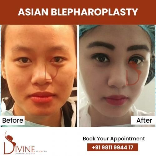 asian-blepharoplasty2.jpg-nggid0279-ngg0dyn-500x500x100-00f0w010c010r110f110r010t010