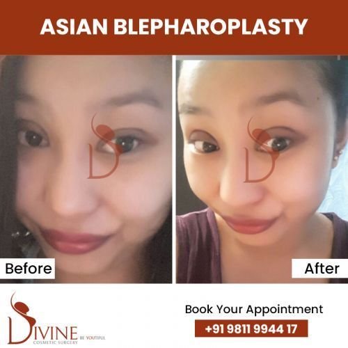 asian-blepharoplasty3.jpg-nggid0280-ngg0dyn-500x500x100-00f0w010c010r110f110r010t010