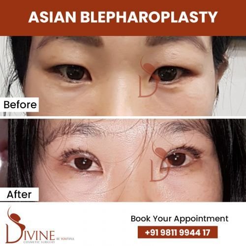 asian-blepharoplasty4.jpg-nggid0281-ngg0dyn-500x500x100-00f0w010c010r110f110r010t010