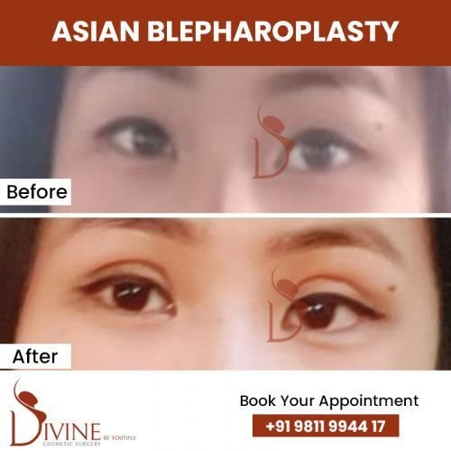 asian-blepharoplasty5.jpg-nggid0282-ngg0dyn-500x500x100-00f0w010c010r110f110r010t010