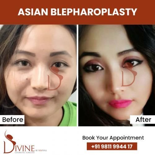 asian-blepharoplasty7.jpg-nggid0283-ngg0dyn-500x500x100-00f0w010c010r110f110r010t010
