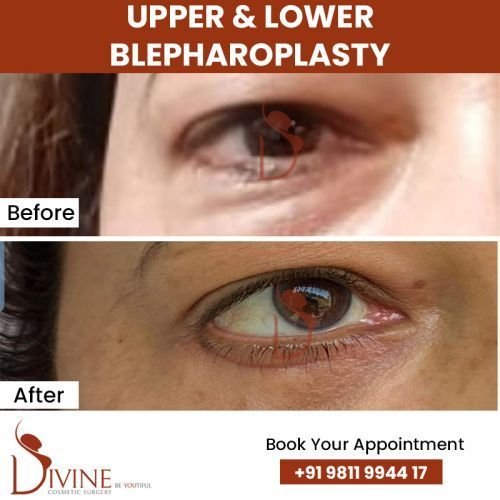 upper-_-Lower-blepharoplasty.jpg-nggid0285-ngg0dyn-500x500x100-00f0w010c010r110f110r010t010