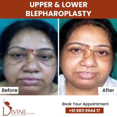 upper-_-Lower-blepharoplasty1.jpg-nggid0286-ngg0dyn-500x500x100-00f0w010c010r110f110r010t010