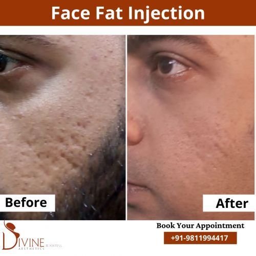 Face-Fat-Injection.png-nggid0272-ngg0dyn-500x500x100-00f0w010c010r110f110r010t010