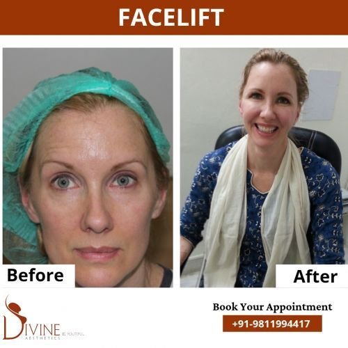 Face-lift-2.png-nggid0276-ngg0dyn-500x500x100-00f0w010c010r110f110r010t010