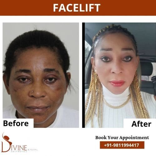 Face-lift-3.png-nggid0273-ngg0dyn-500x500x100-00f0w010c010r110f110r010t010