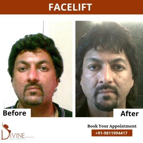 Face-lift-4.png-nggid0274-ngg0dyn-500x500x100-00f0w010c010r110f110r010t010