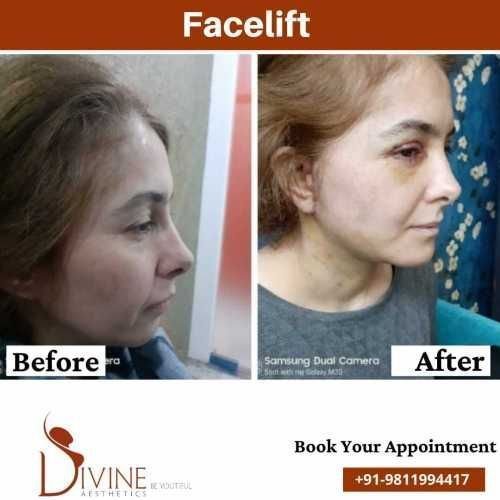 Facelift-before-After-results-Side.jpeg-nggid0278-ngg0dyn-500x500x100-00f0w010c010r110f110r010t010