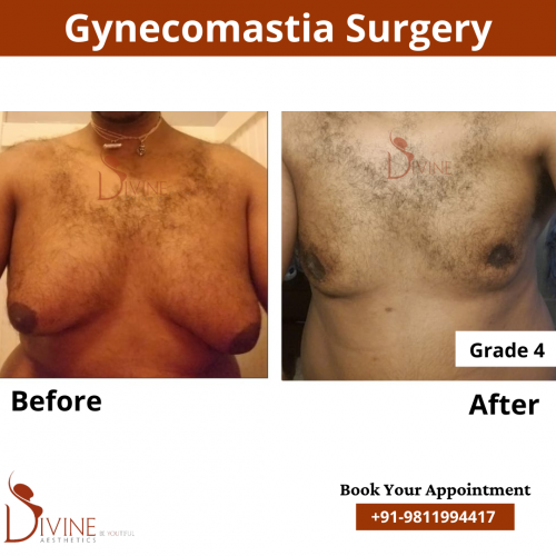 gynecomastia before after pics