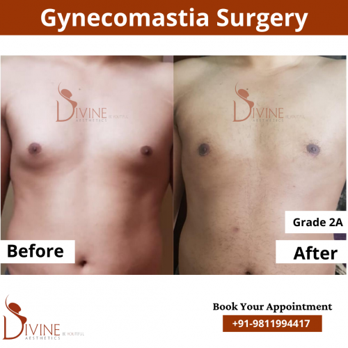 gynecomastia before after pics