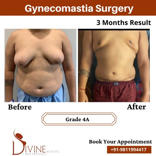 Gynecomastia-Before-After-1-Feb-22