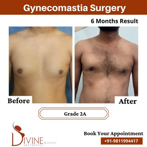 Gynecomastia-Before-After-2-Feb-22