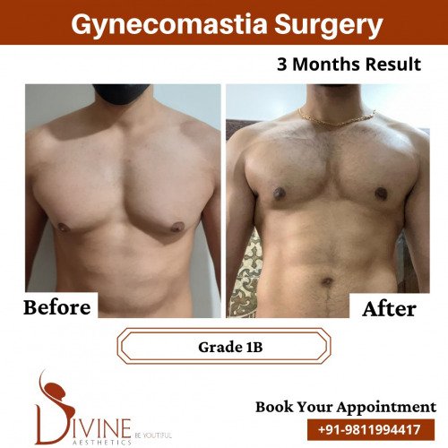 Gynecomastia-Before-After-3-Feb-22
