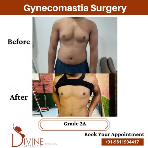 Gynecomastia-Before-After-4-Feb-22