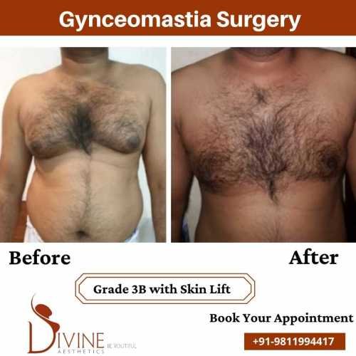 Gynecomastia-Surgery-Grade-3B-with-Skin-Lift-2-1