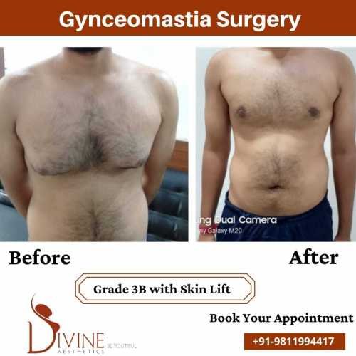 Gynecomastia-Surgery-Grade-3B-with-Skin-Lift-3