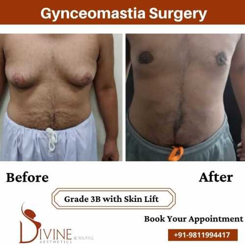Gynecomastia-Surgery-Grade-3B-with-Skin-Lift-4