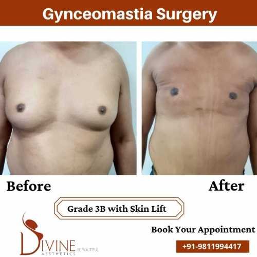Gynecomastia-Surgery-Grade-3B-with-Skin-Lift