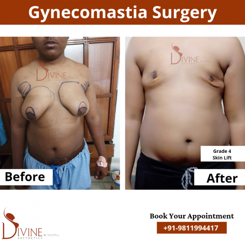 Gynecomastia-Surgery-Grade-4A