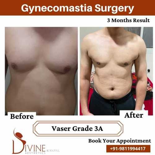 Gynecomastia-before-after-1