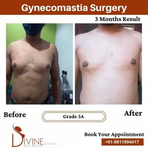 Gynecomastia-before-after-11