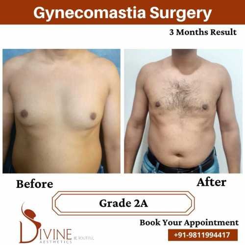 Gynecomastia-before-after-2