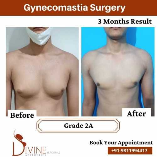 Gynecomastia-before-after-3