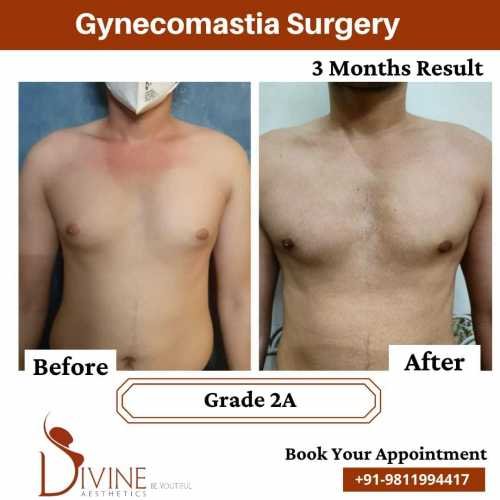 Gynecomastia-before-after-4