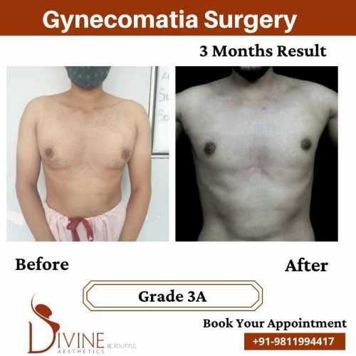 Gynecomastia-before-after-7