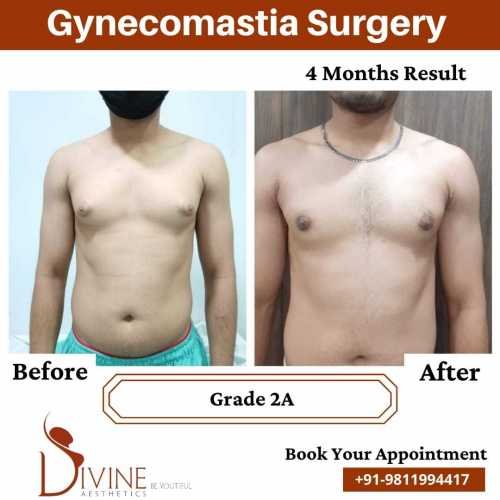 Gynecomastia-before-after-9