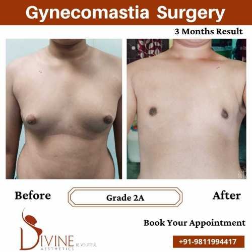 Gynecomastia-before-after-results-after-3-months