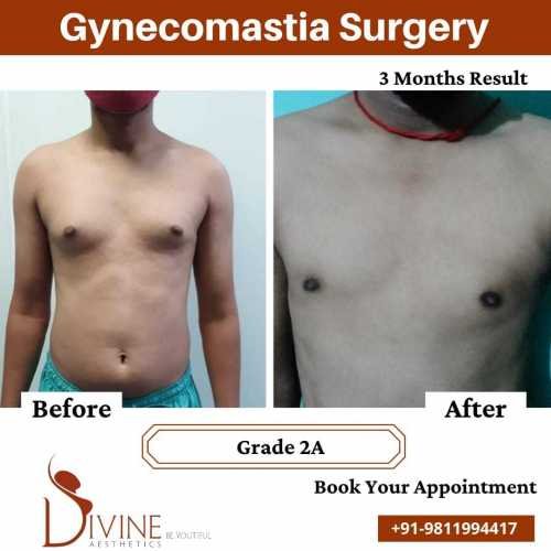 Gynecomastia-before-after-results-after-4-months