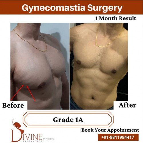 Gynecomastia-surgery-by-Dr-Amit-Gupta-Dec-1