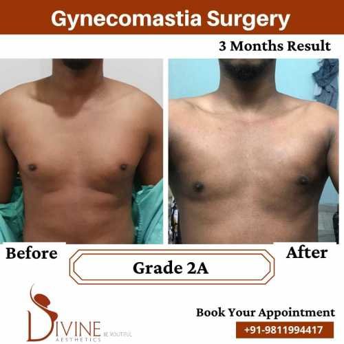 Gynecomastia-surgery-by-Dr-Amit-Gupta-Dec-2