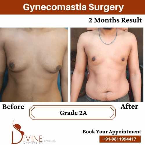 Gynecomastia-surgery-by-Dr-Amit-Gupta-Dec-3