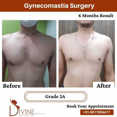 Gynecomastia-surgery-by-Dr-Amit-Gupta-Dec-4