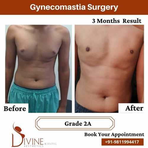 Gynecomastia-surgery-by-Dr-Amit-Gupta-Dec-6