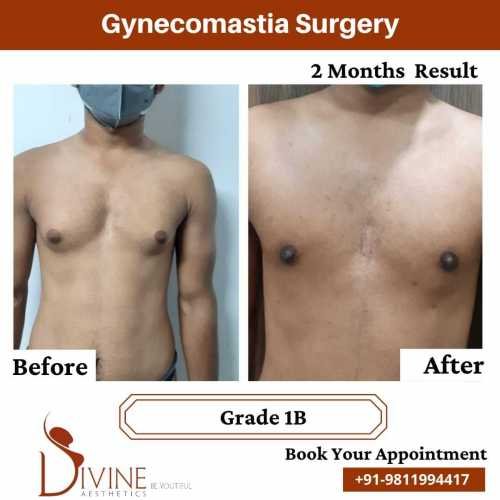 Gynecomastia-surgery-by-Dr-Amit-Gupta-Dec-7