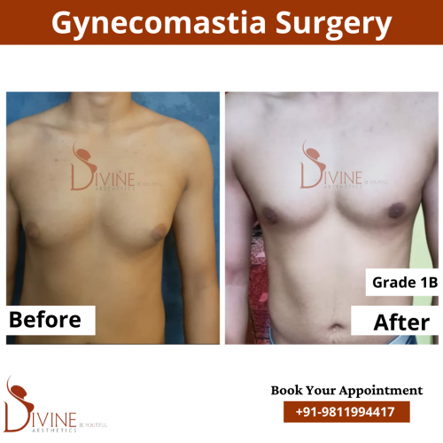 gynecomastia before after pics