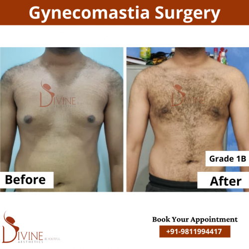 gynecomastia before after pics