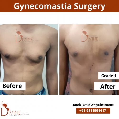 gynecomastia before after pics