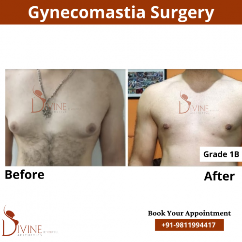 gynecomastia before after pics