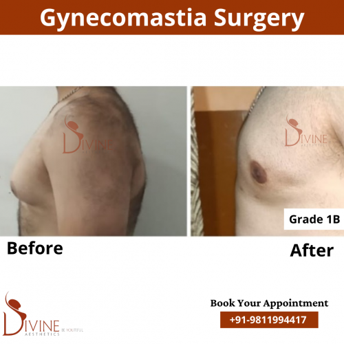 gynecomastia before after pics