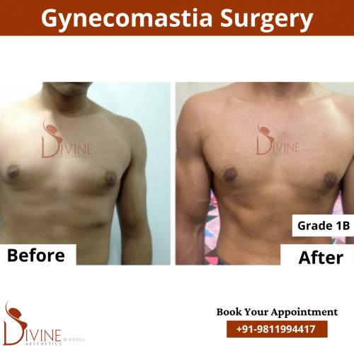 gynecomastia before after pics